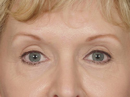 Brow Lift Patient After