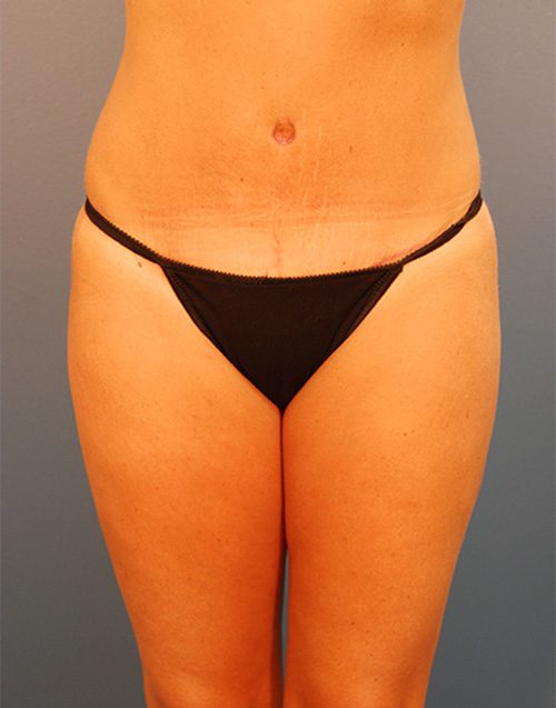 Tummy Tuck, Birmingham, AL