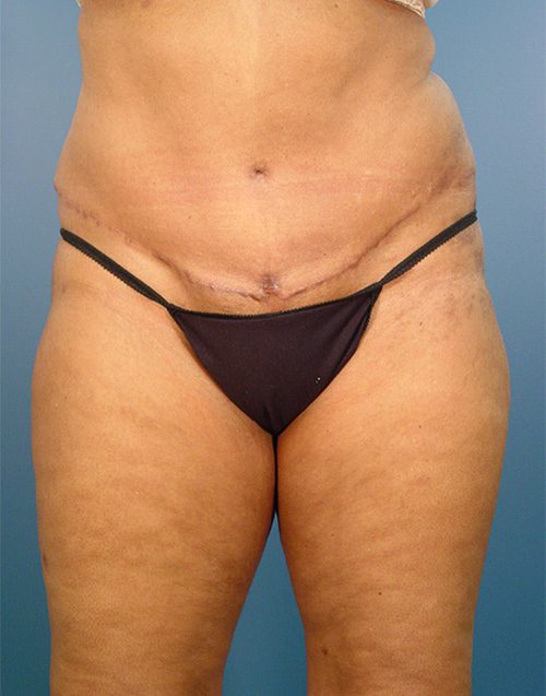 Tummy Tuck Birmingham  Abdominoplasty Near Me